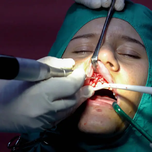 Cuáles son las Desventajas de los Implantes Cigomáticos