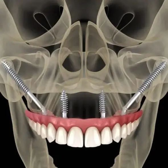 Implantes Cigomáticos