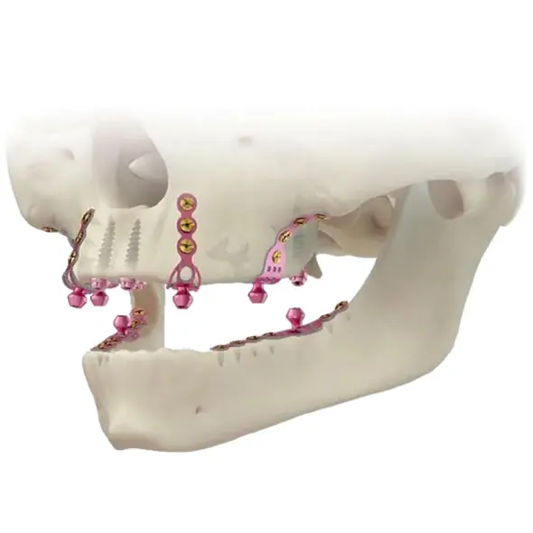 Implantes Corticales
