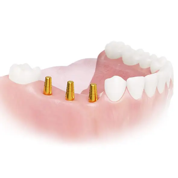 Implantes Monofásicos