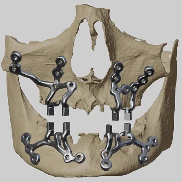 Implantes Personalizados