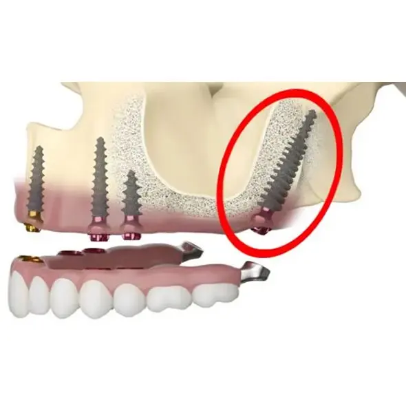 Implantes Pterigoideos