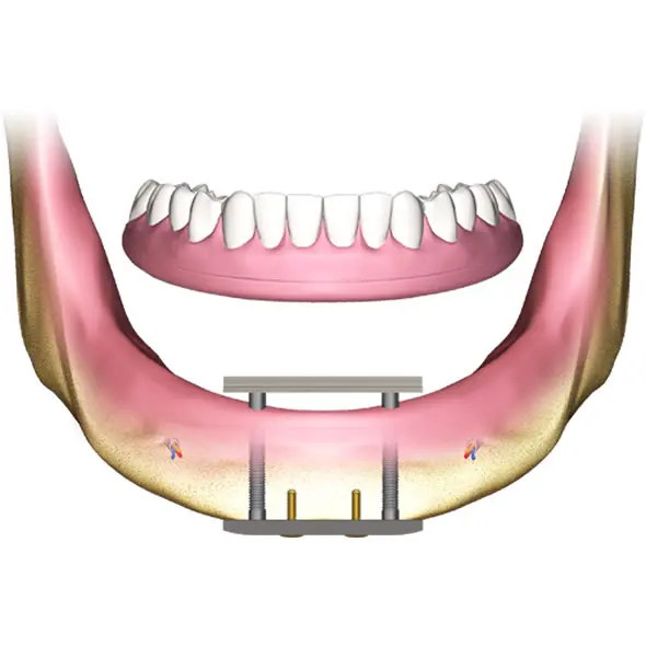 Implantes Transóseos