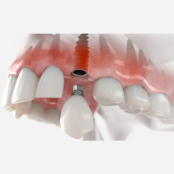 Implantes de Carga Inmediata