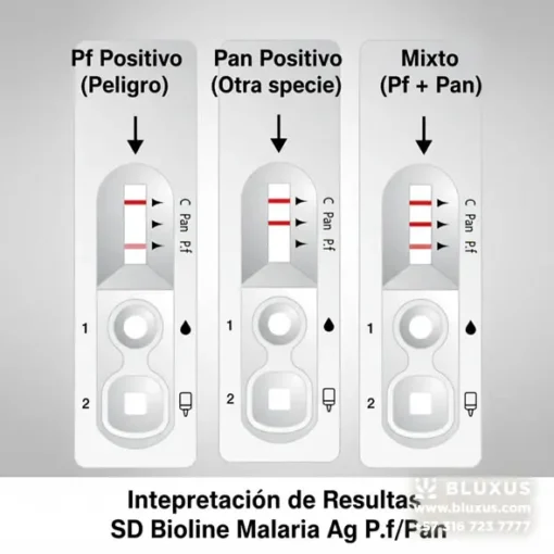 Guía visual de interpretación de resultados para la prueba de Malaria Pf/Pan: Positivo Falciparum, Positivo Pan (otras especies) e Infección Mixta.